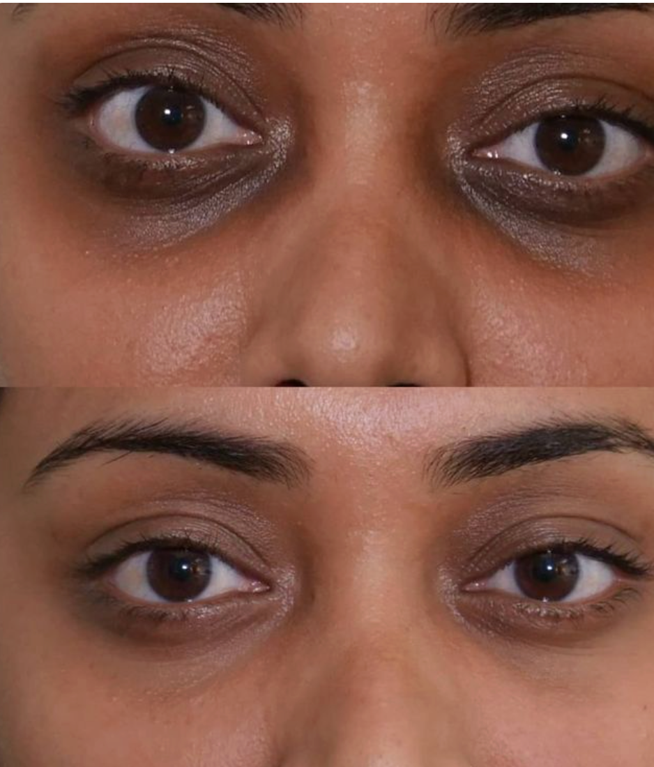 🌿 CurcEyes Patchs anti-cernes au Curcuma & Collagène